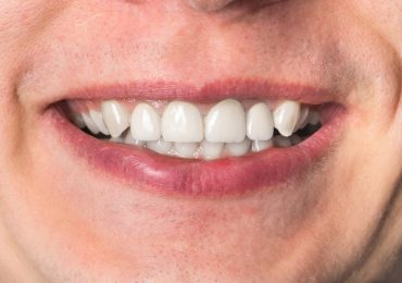 Orthodontics After