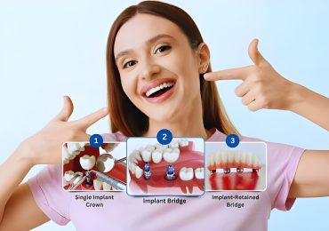Dental Implants